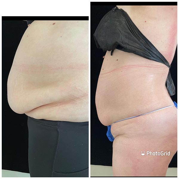 MedSpa Body Countering Before & After