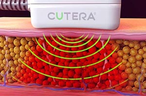 Cutera TruSculpt Body Sculpting & Contouring with Cryolipolysis