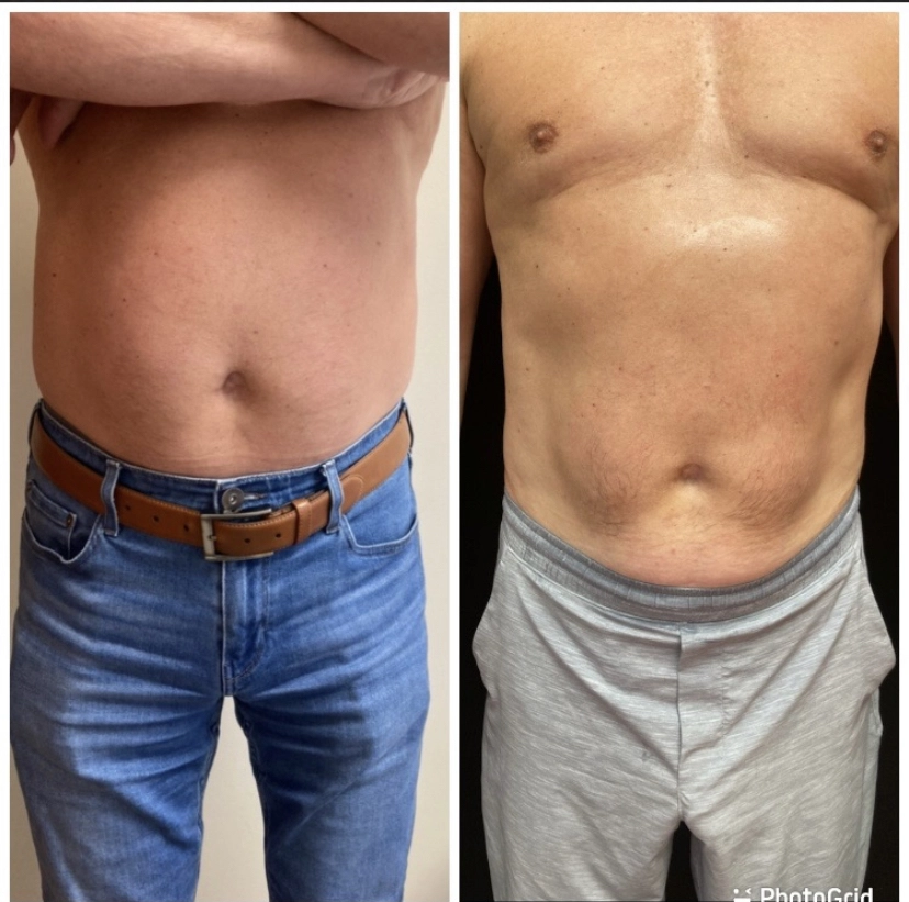 Body_Contouring_2