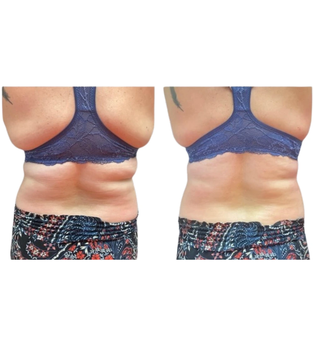 laserskin