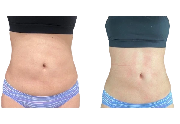 body contouring case 21-v2