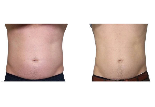 body contouring case 22-v2