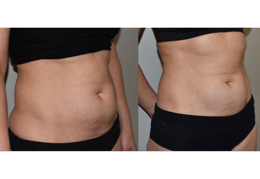 body cotouring case 23