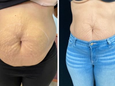body contouring before and after