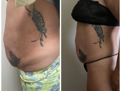 body contouring before and after
