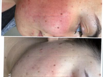 skin rejuvenation before and after